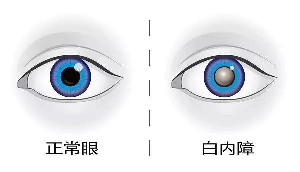 眼睛退化不用怕！白內(nèi)障手術(shù)“辭舊迎新”，讓老年人想怎么看就怎么看！