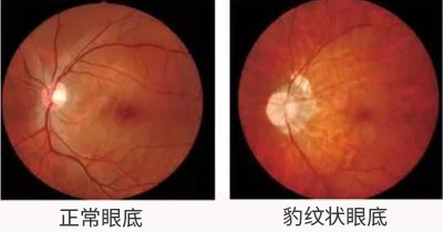 眼底1.jpg