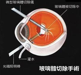 劇烈運動還會導致視網膜脫落？高度近視人群要小心了
