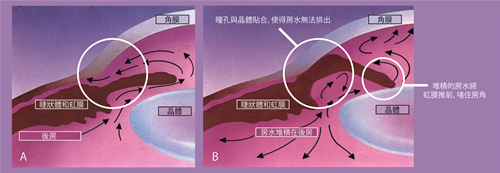 會(huì)導(dǎo)致嚴(yán)重受損的三大致盲性眼病你都知道嗎？