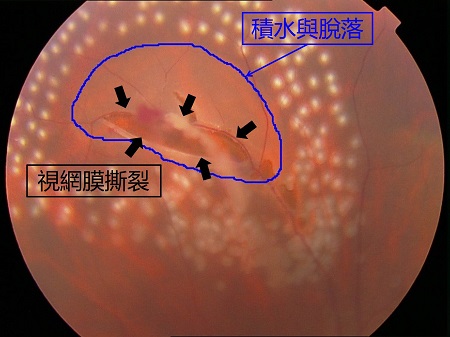 這層膜很重要，視網(wǎng)膜脫落之后極危險(xiǎn)