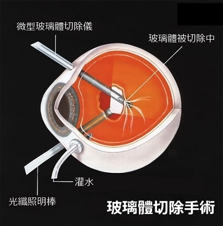 這層膜很重要，視網(wǎng)膜脫落之后極危險(xiǎn)