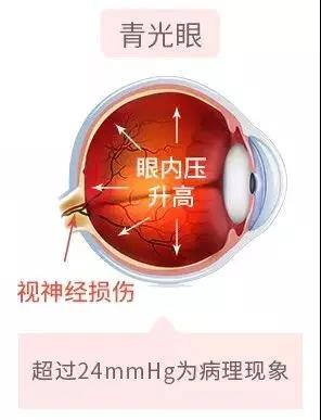 濫用眼藥水，當(dāng)心青光眼找上門！