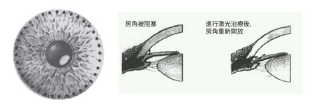 激光虹膜邊緣成形手術