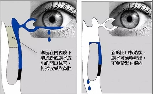 別讓冷空氣變成淚道病的“導火線”！
