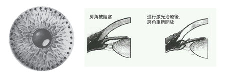 激光虹膜邊緣成形手術(shù)