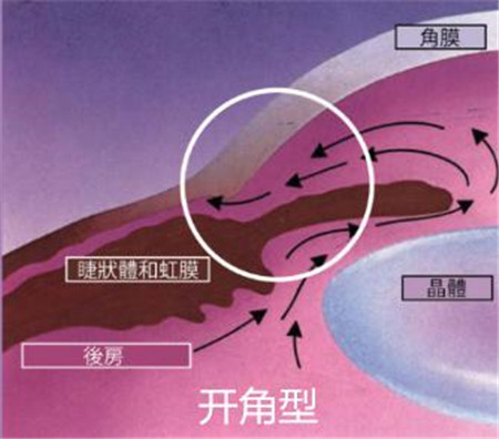 開角型青光眼