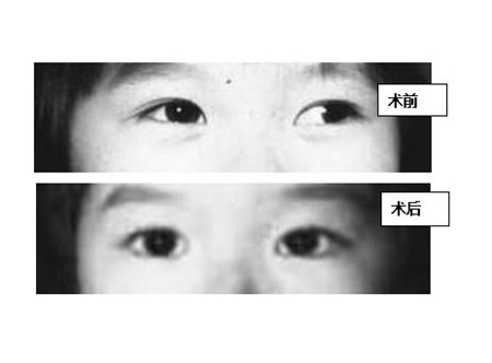 斜視手術(shù)治療