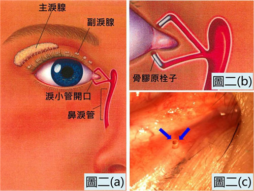 淚小點封閉手術(shù)治療干眼癥