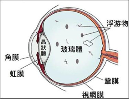 飛蚊產生的原因
