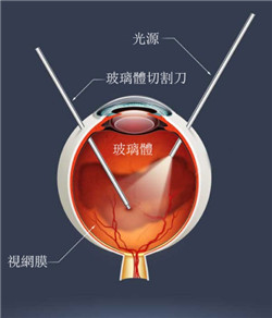 玻璃體切除術治療飛蚊