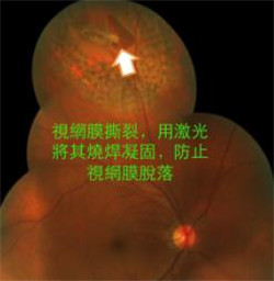 激光治療視網膜撕裂