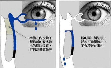 手術(shù)治療先天性淚道阻塞
