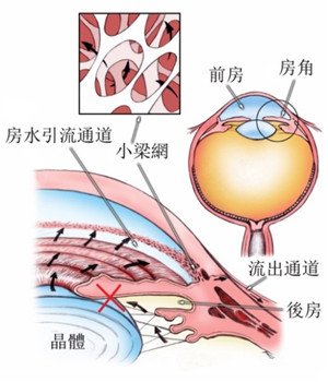 白內(nèi)障和青光眼的關(guān)系