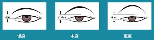 沒睡醒?看起來沒精神?眼瞼下垂可不僅僅是皮膚松弛那么簡單!