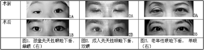 沒睡醒?看起來沒精神?眼瞼下垂可不僅僅是皮膚松弛那么簡單!