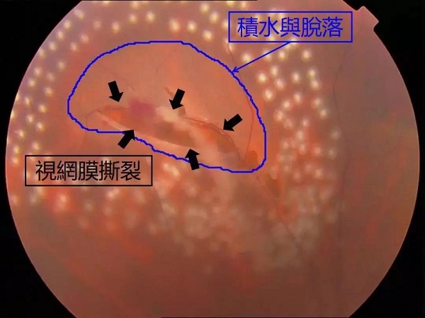 高度近視為什么會引起視網膜脫落呢？