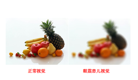眼球震顫對(duì)視力的影響