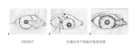 翼狀胬肉手術切除
