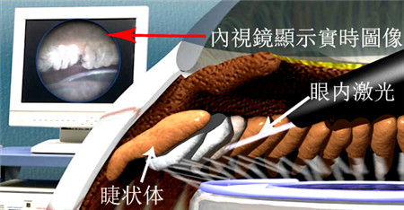 內視鏡下睫狀體光凝固術
