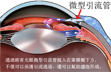 青光眼引流管手術