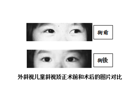 斜視矯正手術(shù)