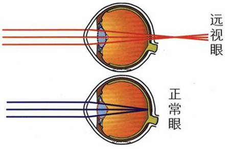 遠(yuǎn)視形成的原因