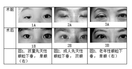 上瞼下垂治療