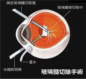 玻璃體切除手術(shù)
