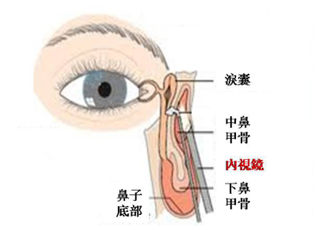 淚囊鼻腔吻合術(shù)