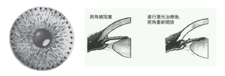 青光眼手術