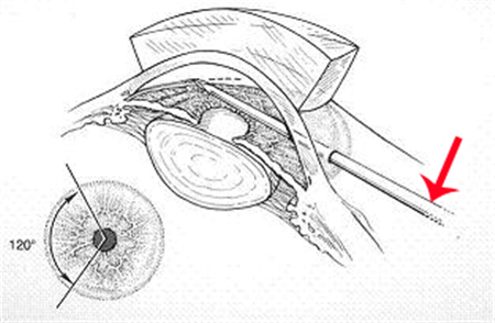 房角切開手術(shù)