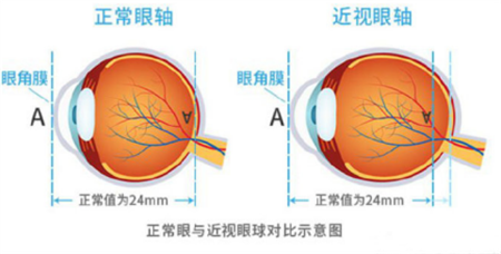 戴眼鏡會導致近視度數(shù)上漲嗎