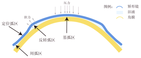 角膜塑形鏡