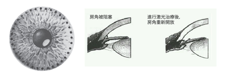 北京青光眼治療哪個(gè)醫(yī)院好