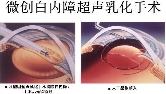 北京治療白內(nèi)障多少錢
