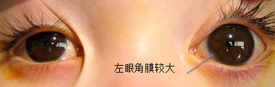 北京治療兒童青光眼哪個醫院好