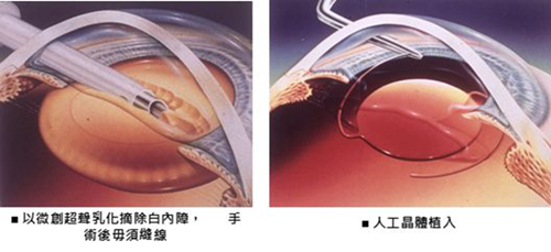 白內障手術